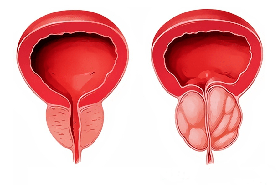 an inflammatory and healthy prostate