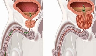 causes of prostatitis in men