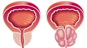 reasons for the development of prostatitis and prostate adenoma