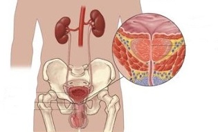 symptoms and treatment of chronic prostatitis